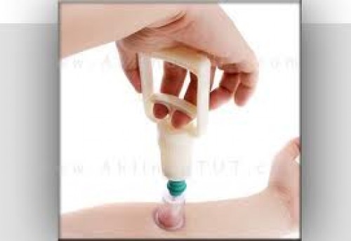 Hadisler ile "Hacamat"