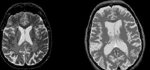 Huntington Hastalığının tedavisinde umut ışığı