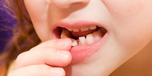 Süt dişlerini erken çektirmeyin