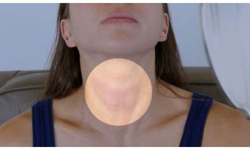 İşte guatr hakkında bilinmeyenler