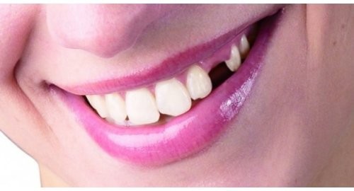 Dişlerin en büyük düşmanı