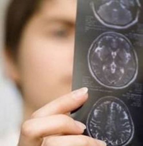 Beyindeki kök hücreler, tümöre karşı koruyor