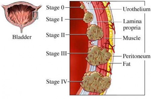 Mesane Kanseri Belirtileri