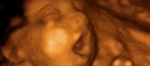 Sigara içen annenin ultrason görüntüsü