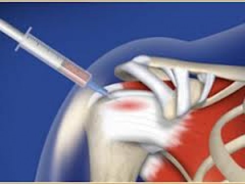 Ortopedik sorunlara PRP çözümü