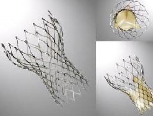 Transkateter aort kapak implantasyonu (TAVİ) umut veriyor