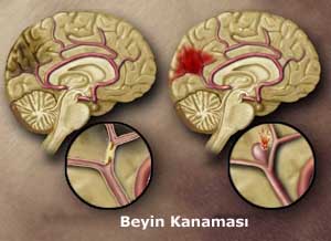  Beyin kanaması yapabilir! 