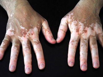  Vitiligo tedavisinde umut ışığı 