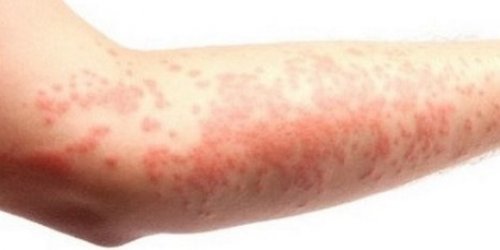  Gece kaşıntılarına dikkat 